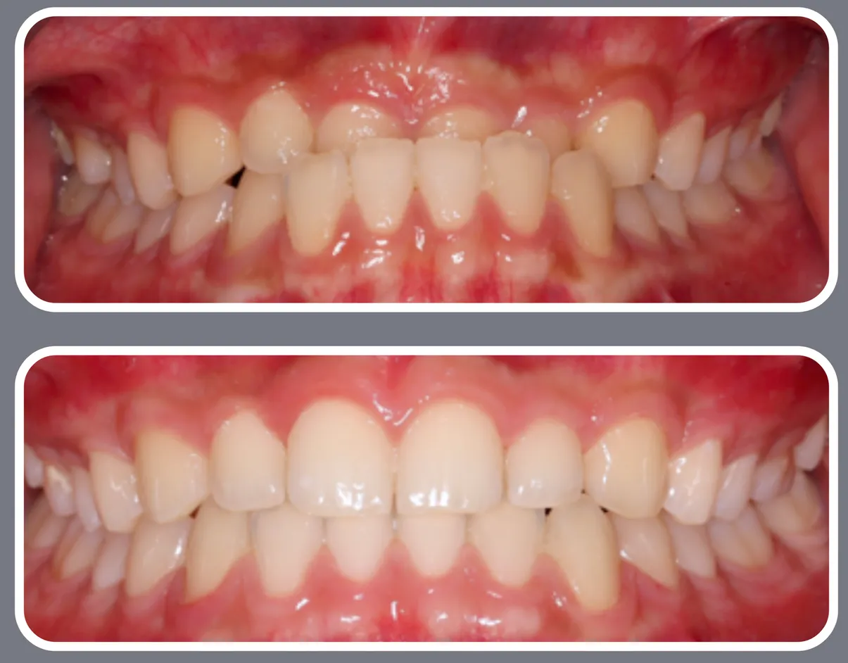 An orthodontic case showing severe crowding and a misaligned bite in the top photo. The bottom photo shows a perfectly straight smile with corrected alignment.