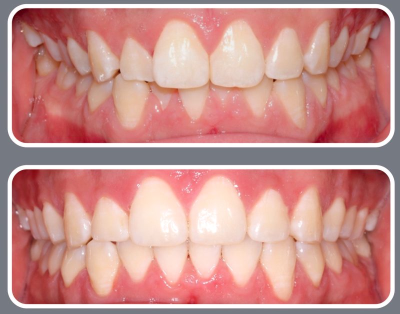 A case focusing on tooth spacing and bite alignment. The top photo shows visible gaps and slight protrusion; the bottom photo shows the teeth tightly aligned and straightened.