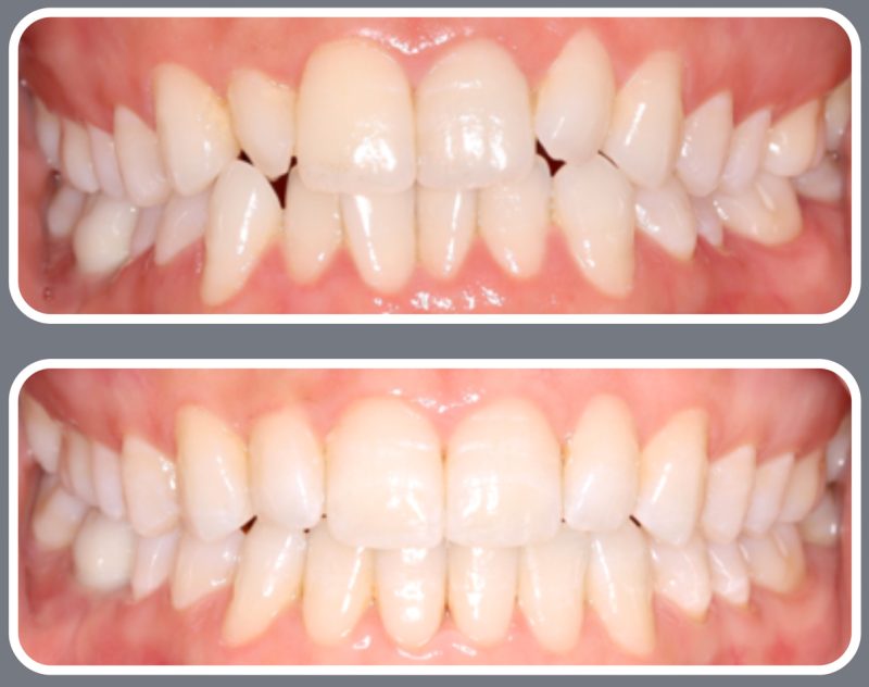 A case showing moderate crowding and overlapping of the front incisors. The bottom photo shows the results of orthodontic treatment with a uniform, symmetrical smile.