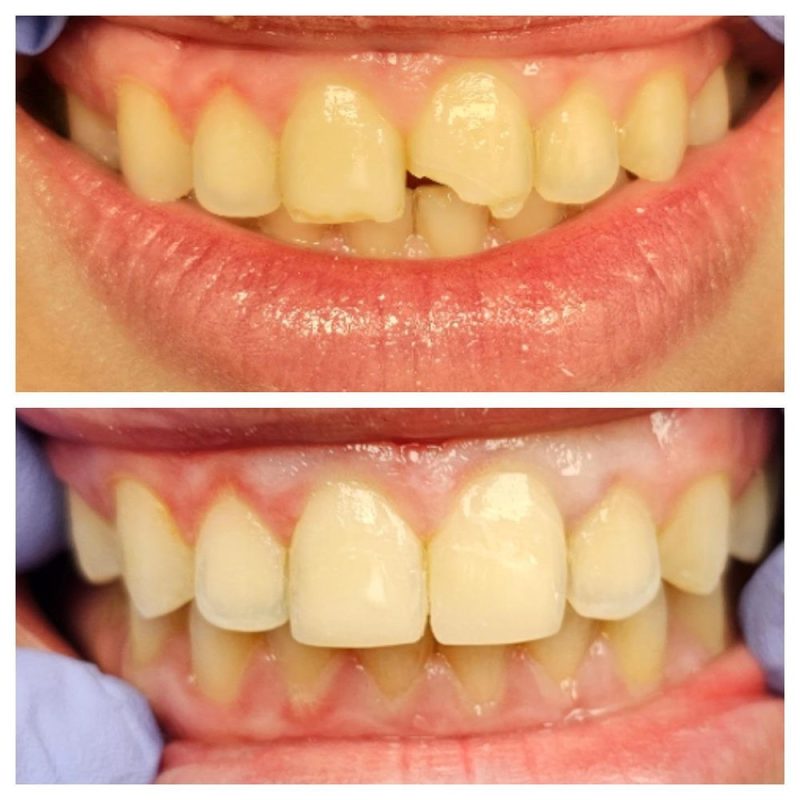 A restorative case showing a chipped and worn front tooth in the top photo. The bottom photo shows the tooth repaired with a crown or bonding, restoring a smooth, natural shape and lighter color.
