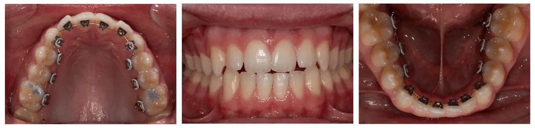 Brava Braces