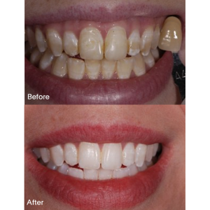 ICON for White Spots before and after