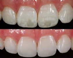 ICON for White Spots before and after