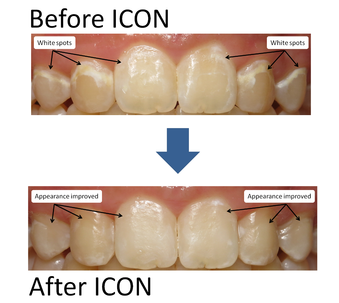 ICON for White Spots before and after