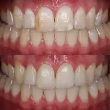 ICON for White Spots before and after