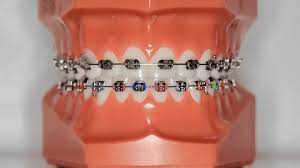 Metal Braces