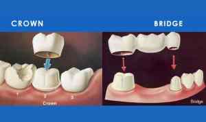 Dental Crowns & Bridges