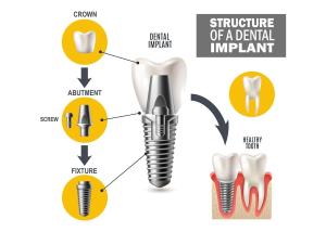 Graphic for dental implant crowns