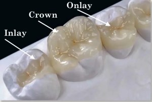 Inlays & Onlays Crown