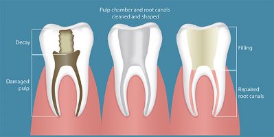 Non-Surgical Root Canal