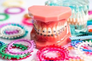 Colorful brackets on a braces model
